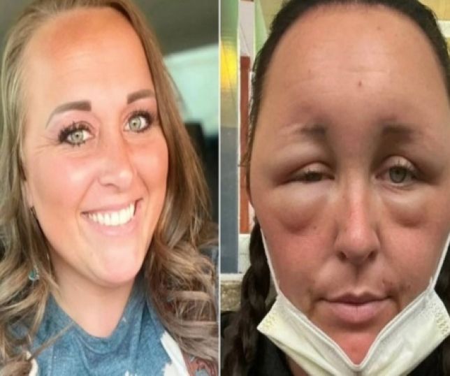 Mulher fica com o rosto deformado após terrível reação alérgica a tintura para cabelo
