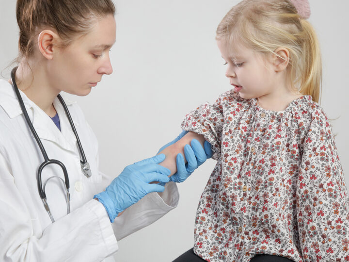 Doença comum na infância, a dermatite atópica atinge 2 em cada 10 crianças com menos de 5 anos